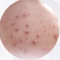 Close-up kulit: Body Acne-Prone Care