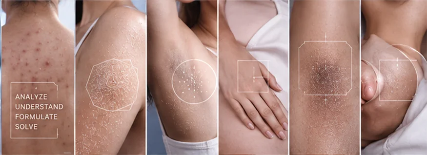 Close-up area tubuh: acne-prone, dry & rough, odor-prone, friction areas, uneven tone, dan sensitive skin